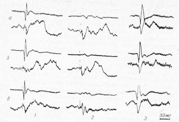 Избирательность влияния CII области коры при ее охлаждении на потенциалы ретикулярной формации среднего мозга (нижний луч), вызванный при стимуляции нервов контралатеральной стороны (1), нервов ипсилатеральной стороны (2), вспышками света (3)
