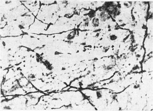 Терминальная дегенерация кортикофугальных волокон в срединном центре (СМ) таламуса кошки после коагуляции II соматосенсорной области коры